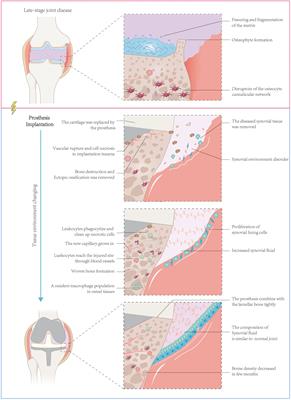 Nano wear particles and the periprosthetic microenvironment in aseptic loosening induced osteolysis following joint arthroplasty